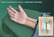 Endoscopic Carpal Tunnel Release Surgery