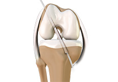 ACL Reconstruction (Patellar and Hamstring Tendon)