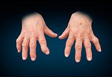 Arthritis Surgery for Thumb and Digits