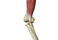 Biceps Tendon Repair