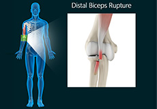 Distal Bicep Rupture