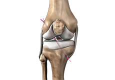 Knee Reconstruction
